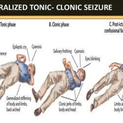 Post seizure management for parents ati