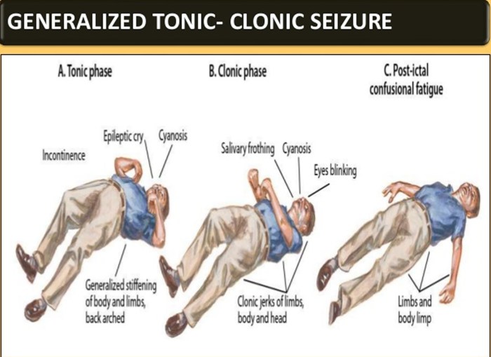 Post seizure management for parents ati